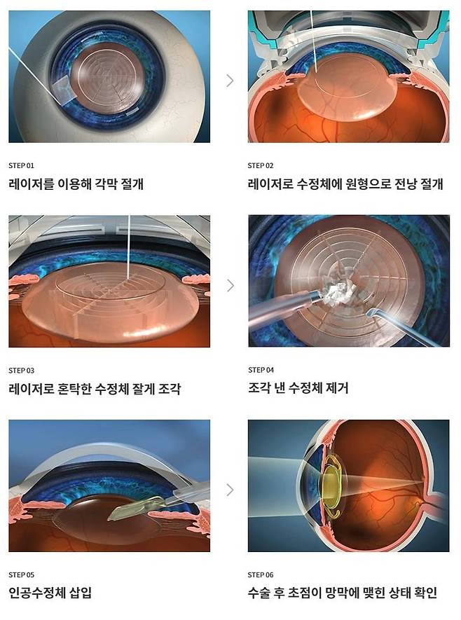 인공수정체 렌즈, 견적에서 빠지면 얼마나 벌어질까